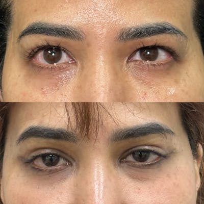 Upper Blepharoplasty Before & After Gallery - Patient 574758 - Image 1