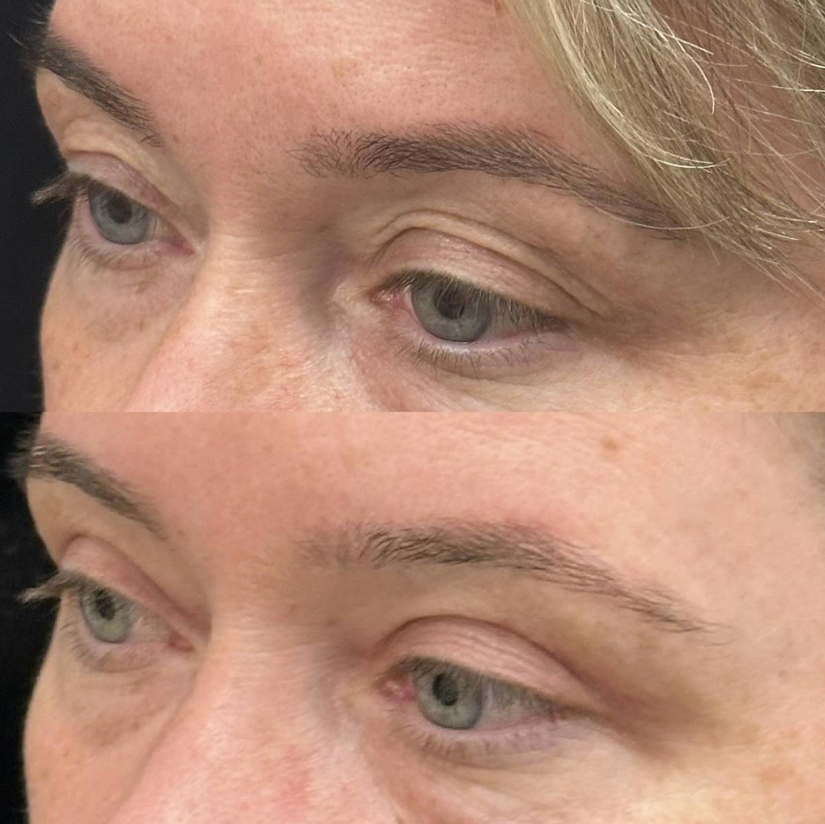  Upper Blepharoplasty Before & After Gallery - Patient 273750 - Image 3