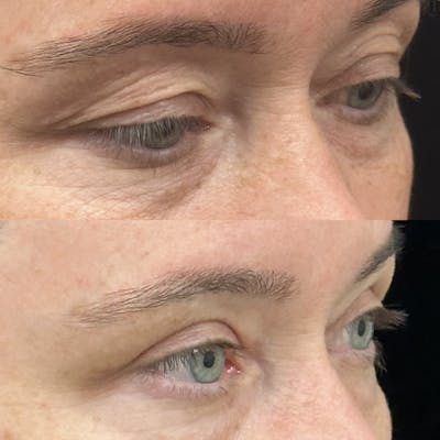 Upper Blepharoplasty Before & After Gallery - Patient 273750 - Image 2