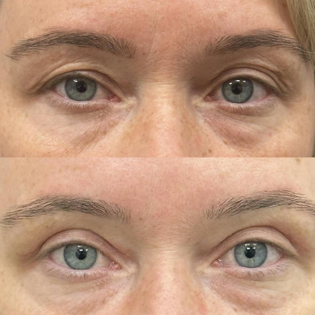  Upper Blepharoplasty Before & After Gallery - Patient 273750 - Image 1