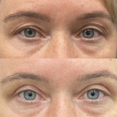 Upper Blepharoplasty Before & After Gallery - Patient 273750 - Image 1