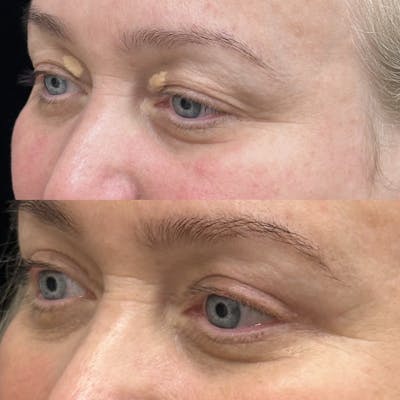 Upper Blepharoplasty Before & After Gallery - Patient 336648 - Image 3