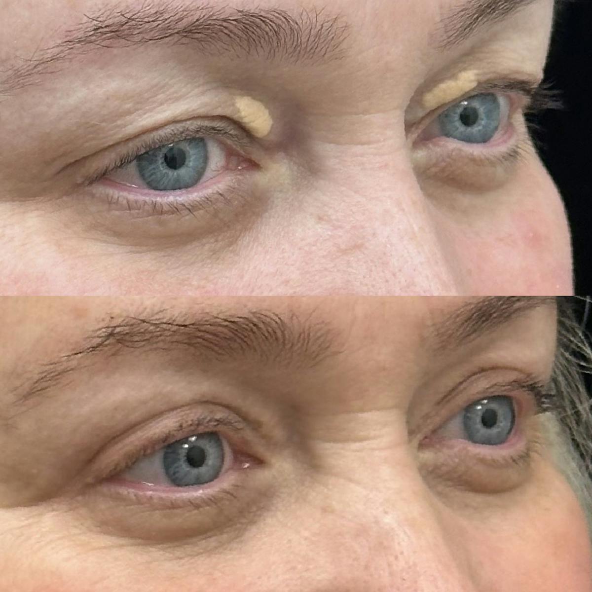  Upper Blepharoplasty Before & After Gallery - Patient 336648 - Image 2