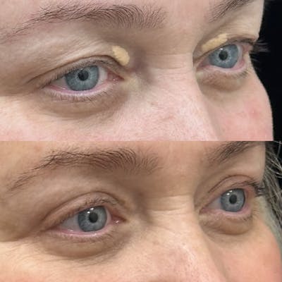 Upper Blepharoplasty Before & After Gallery - Patient 336648 - Image 2