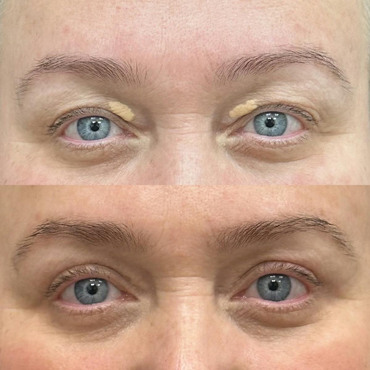  Upper Blepharoplasty Before & After Gallery - Patient 336648 - Image 1