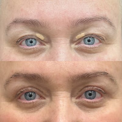 Upper Blepharoplasty Before & After Gallery - Patient 336648 - Image 1