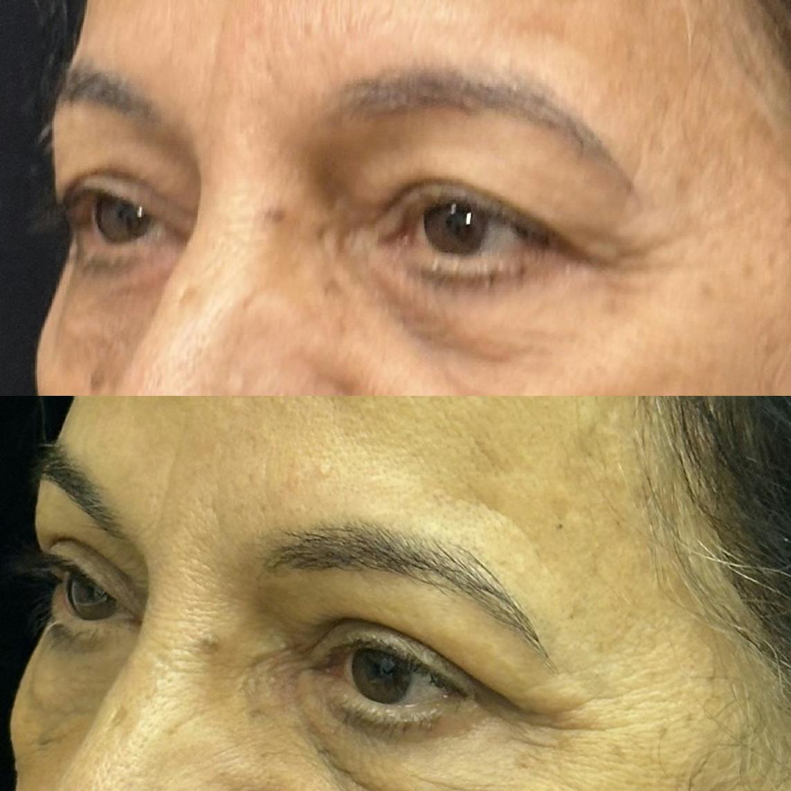  Upper Blepharoplasty Before & After Gallery - Patient 344242 - Image 3
