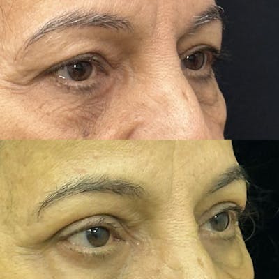 Upper Blepharoplasty Before & After Gallery - Patient 344242 - Image 2