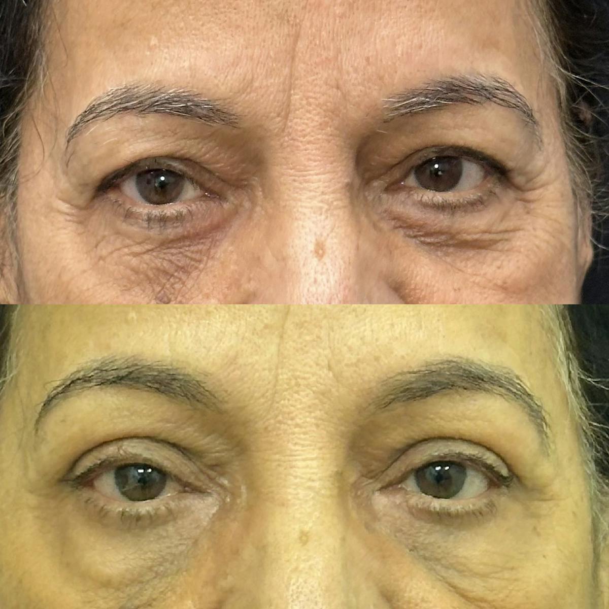  Upper Blepharoplasty Before & After Gallery - Patient 344242 - Image 1