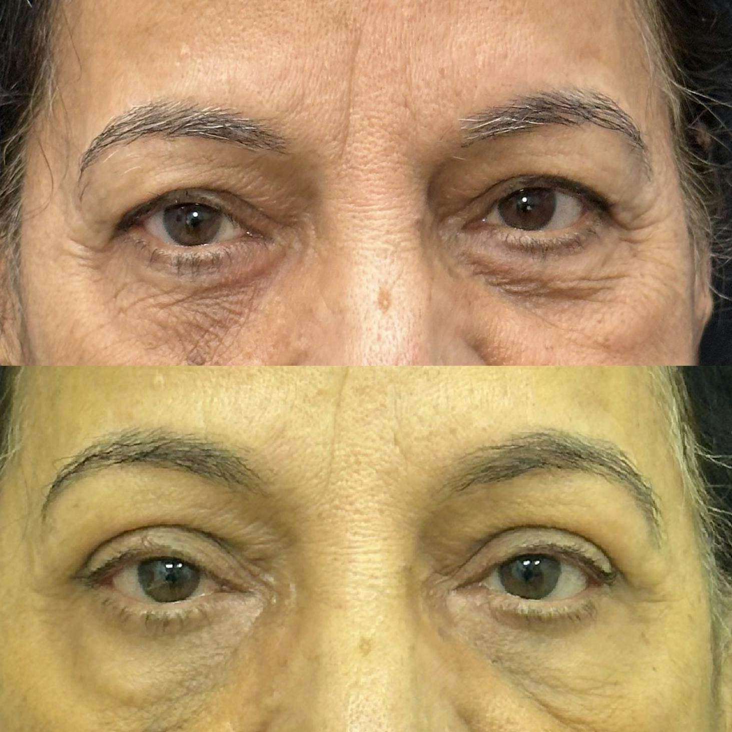  Upper Blepharoplasty Before & After Gallery - Patient 344242 - Image 1