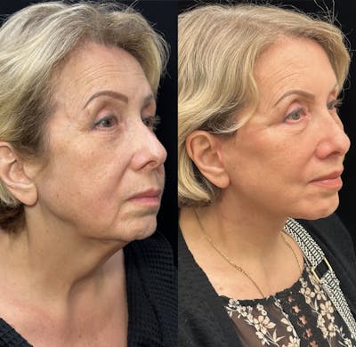 CO2 Laser Face Resurfacing Before & After Gallery - Patient 345109 - Image 1