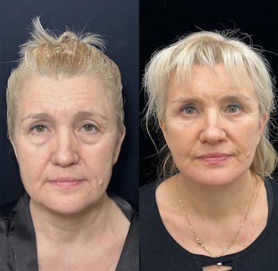 CO2 Laser Face Resurfacing Before & After Gallery - Patient 154960 - Image 1