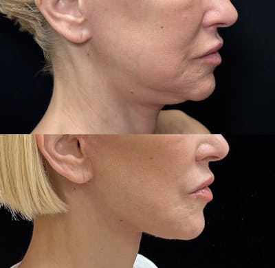 CO2 Laser Face Resurfacing Before & After Gallery - Patient 374527 - Image 1