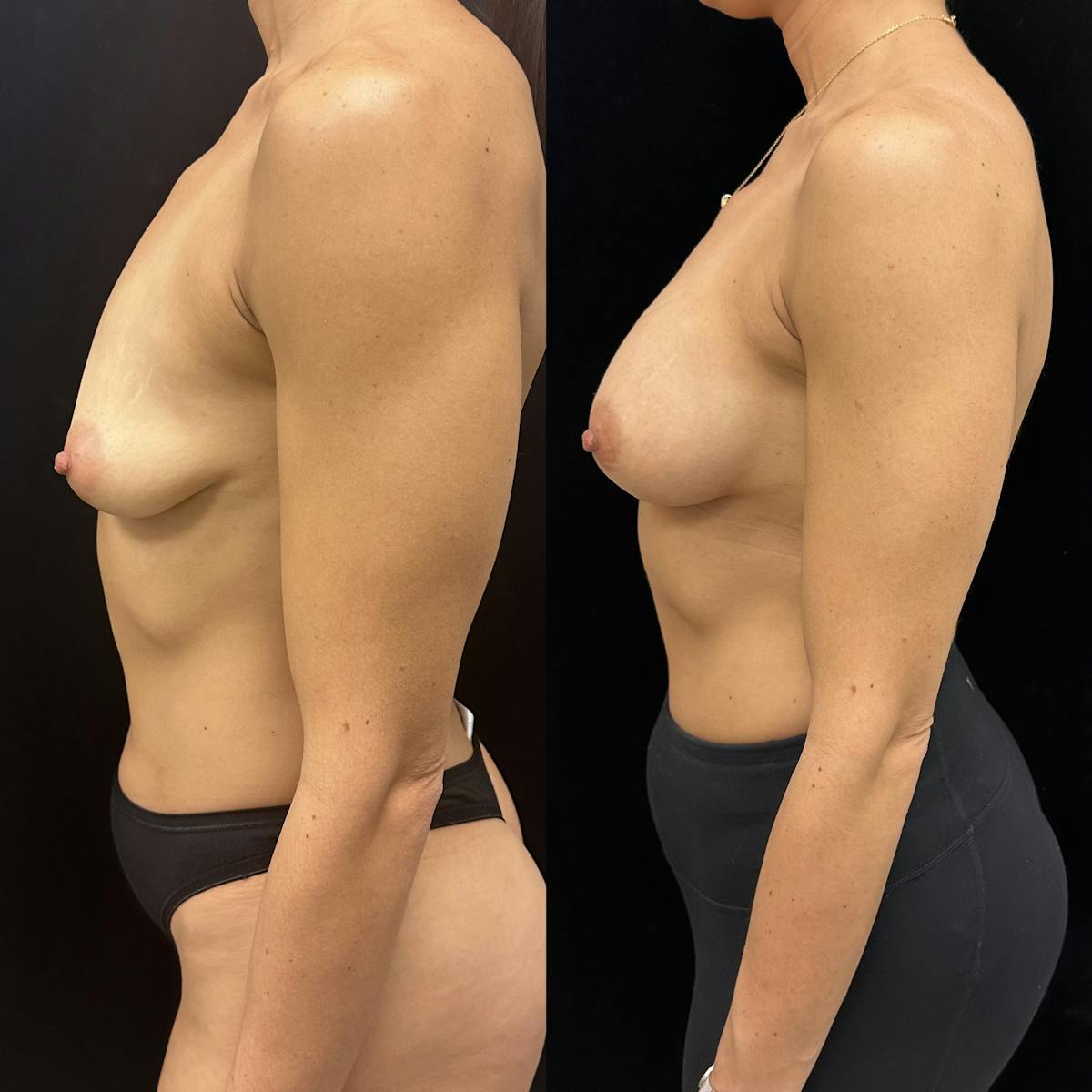  Breast Augmentation Before & After Gallery - Patient 410904 - Image 3