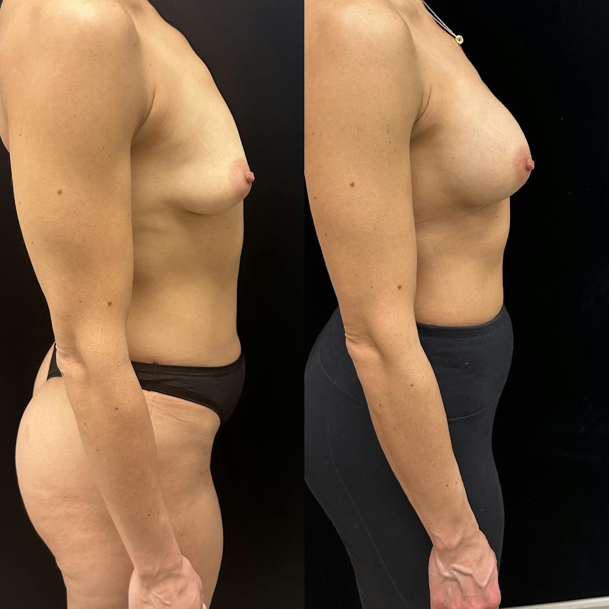  Breast Augmentation Before & After Gallery - Patient 410904 - Image 2