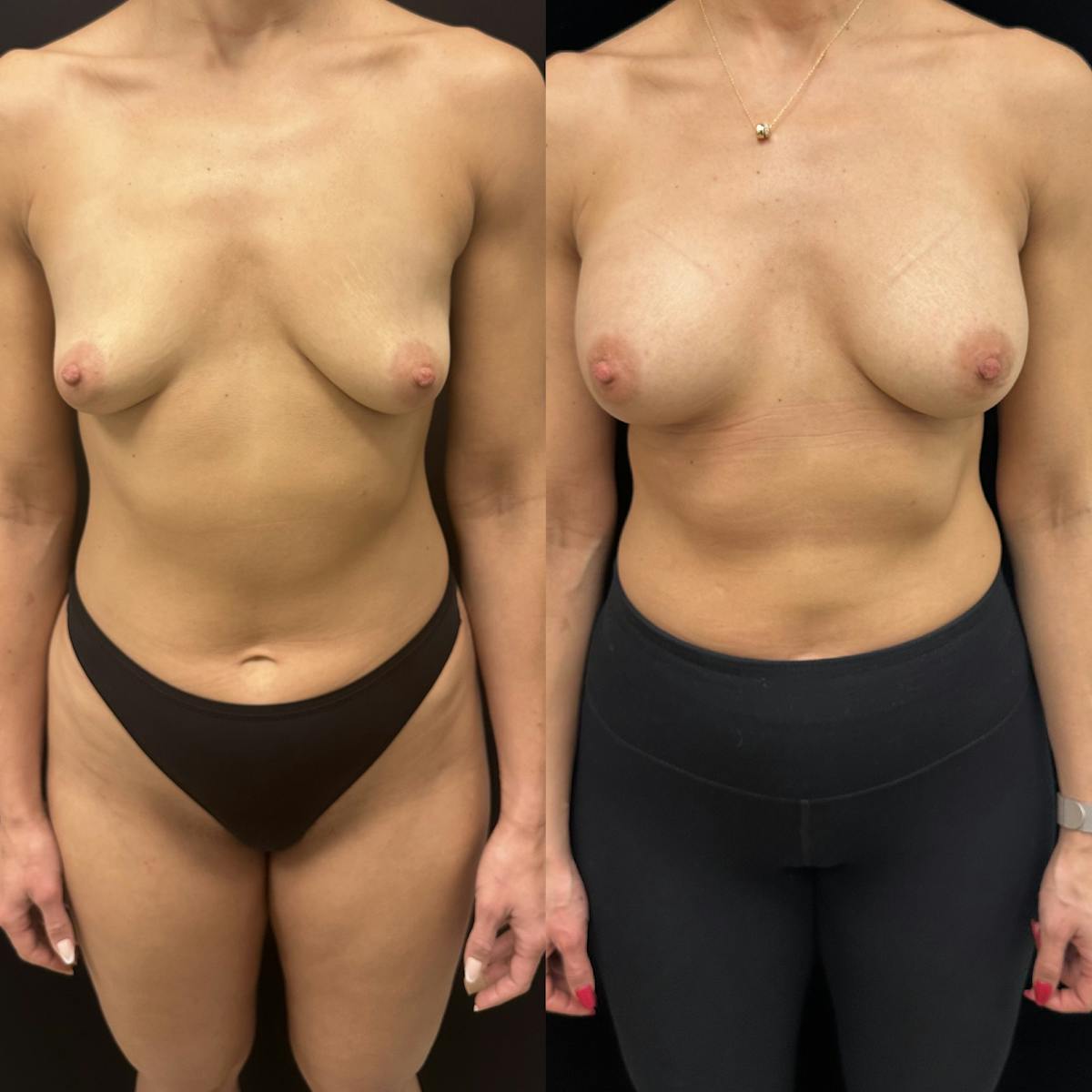  Breast Augmentation Before & After Gallery - Patient 410904 - Image 1
