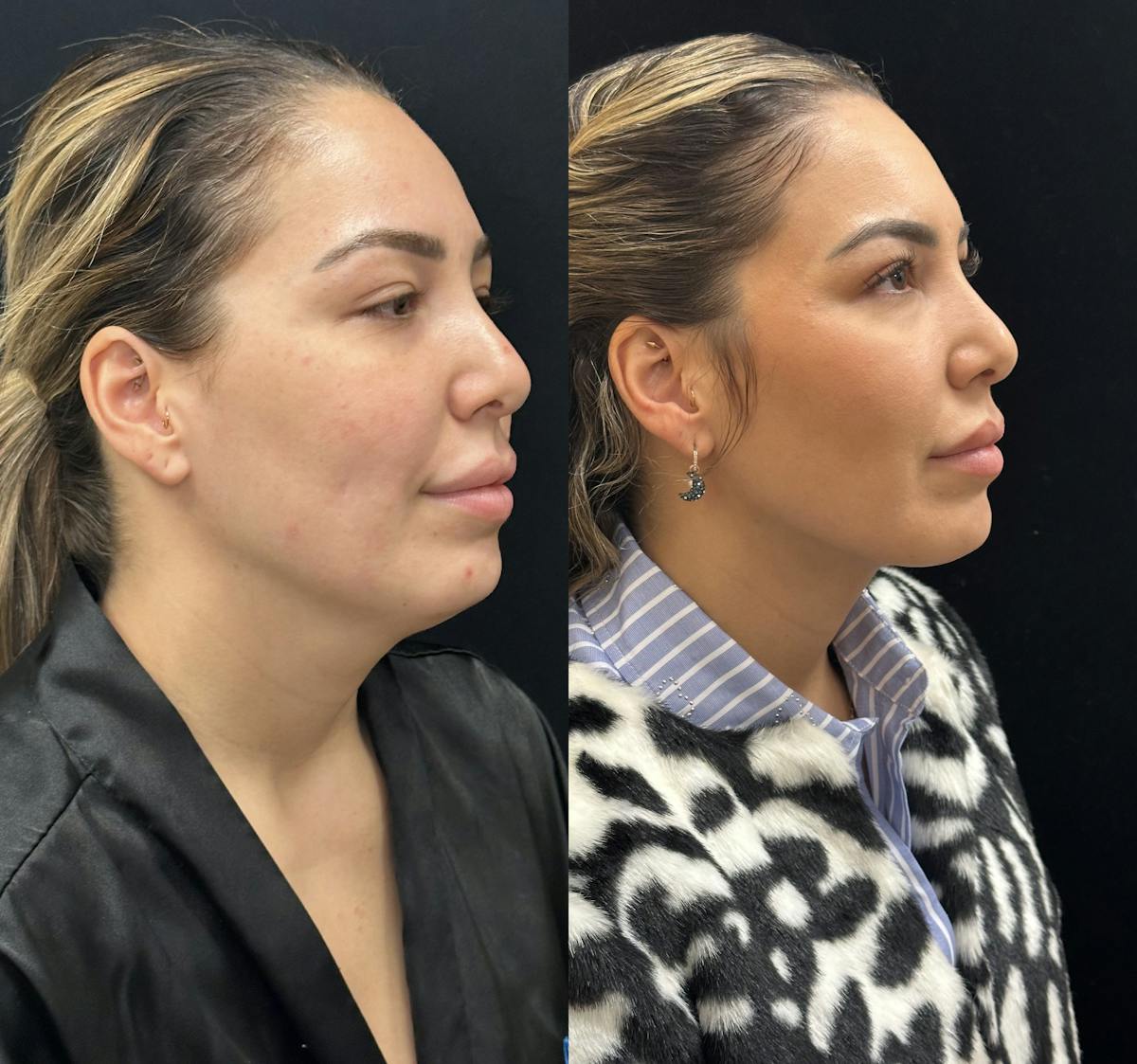 Chin & Neck Lipo Sculpting Before & After Gallery - Patient 192918 - Image 2