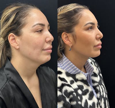 Chin & Neck Lipo Sculpting Before & After Gallery - Patient 192918 - Image 2