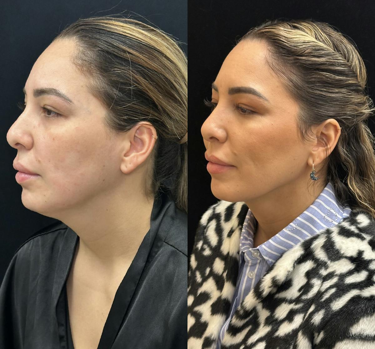Chin & Neck Lipo Sculpting Before & After Gallery - Patient 192918 - Image 4