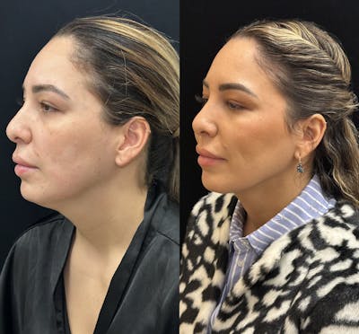 Chin & Neck Lipo Sculpting Before & After Gallery - Patient 192918 - Image 4