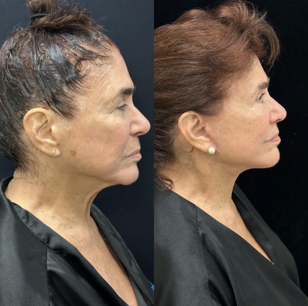 CO2 Laser Face Resurfacing Before & After Gallery - Patient 365723 - Image 3