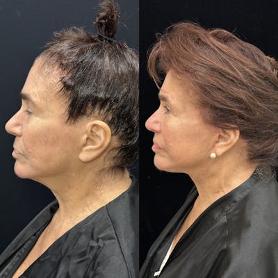 Deep Plane Facelift Before & After Gallery - Patient 343590 - Image 5