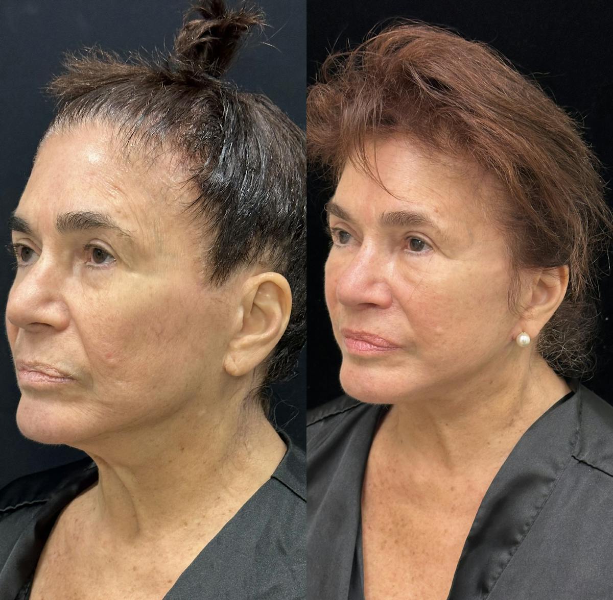 CO2 Laser Face Resurfacing Before & After Gallery - Patient 365723 - Image 4