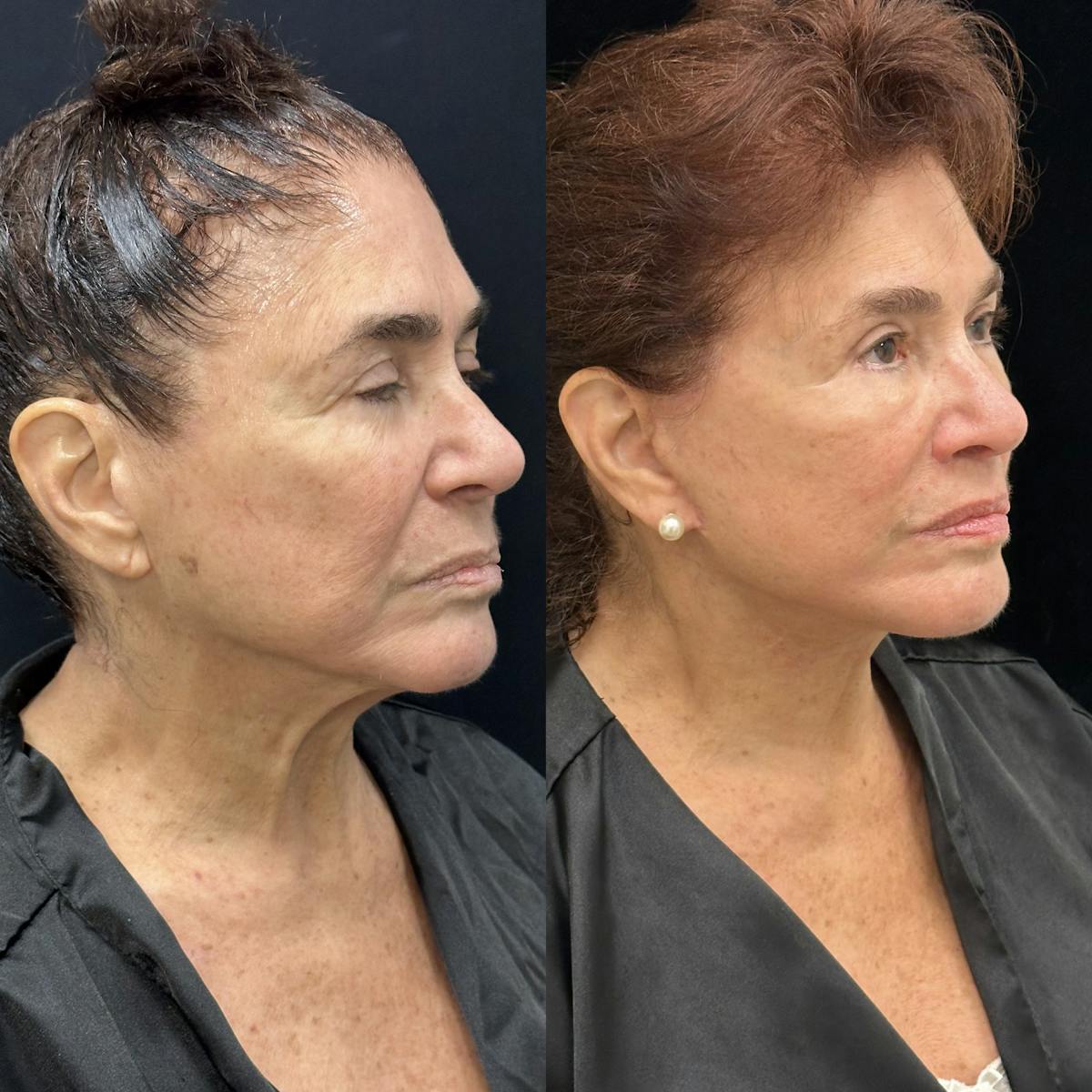 CO2 Laser Face Resurfacing Before & After Gallery - Patient 365723 - Image 2