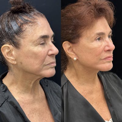 Deep Plane Facelift Before & After Gallery - Patient 343590 - Image 2
