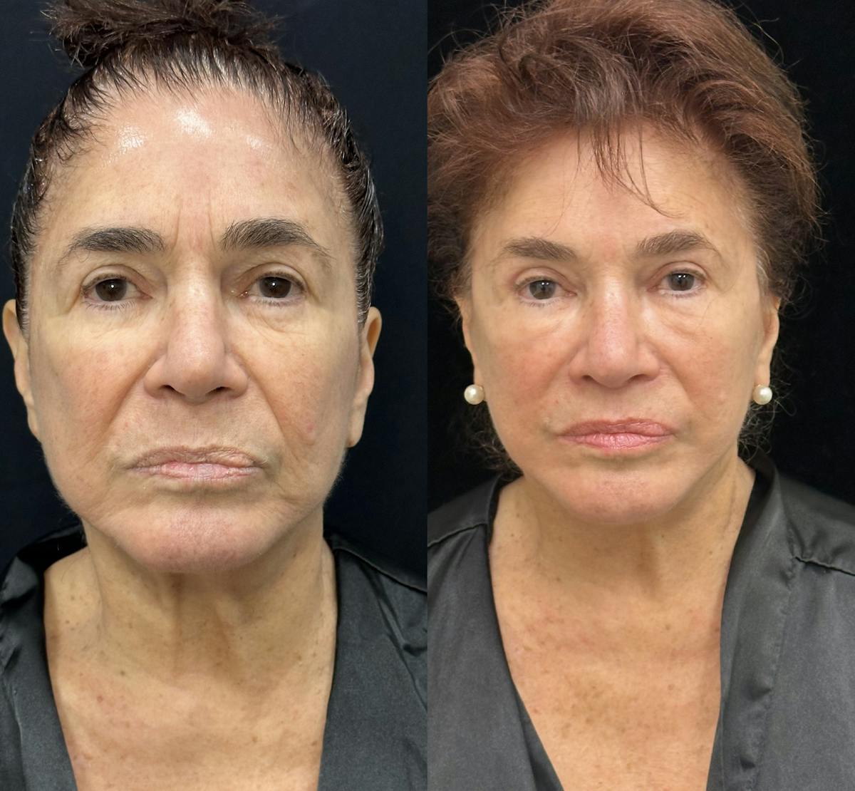 CO2 Laser Face Resurfacing Before & After Gallery - Patient 365723 - Image 1