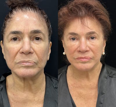 Deep Plane Facelift Before & After Gallery - Patient 343590 - Image 1