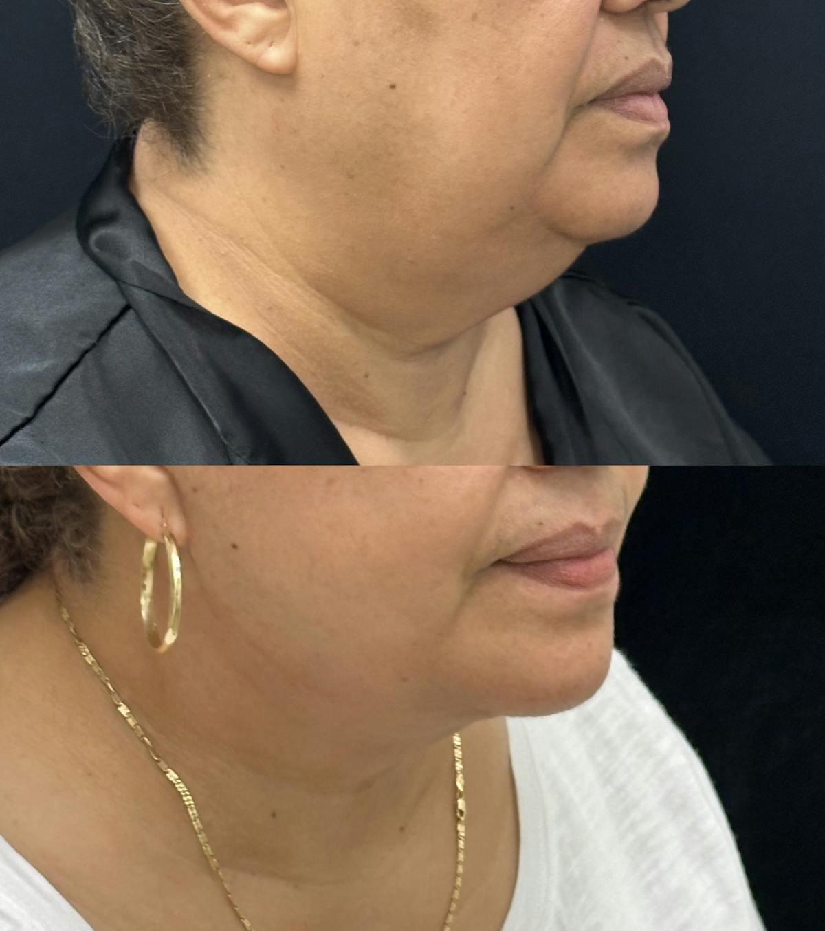 Deep Plane Facelift Before & After Gallery - Patient 966814 - Image 2