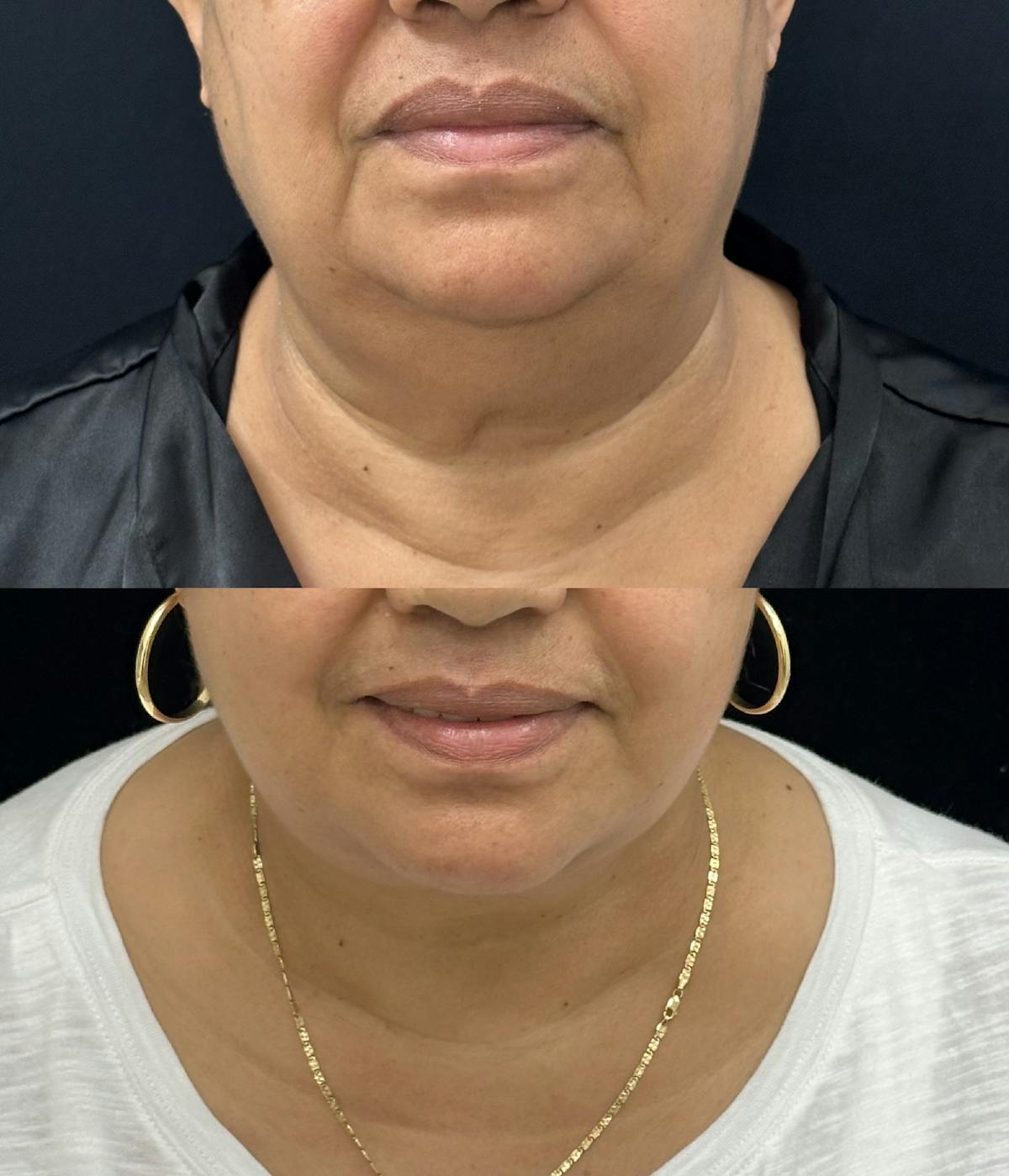 Deep Plane Facelift Before & After Gallery - Patient 966814 - Image 1