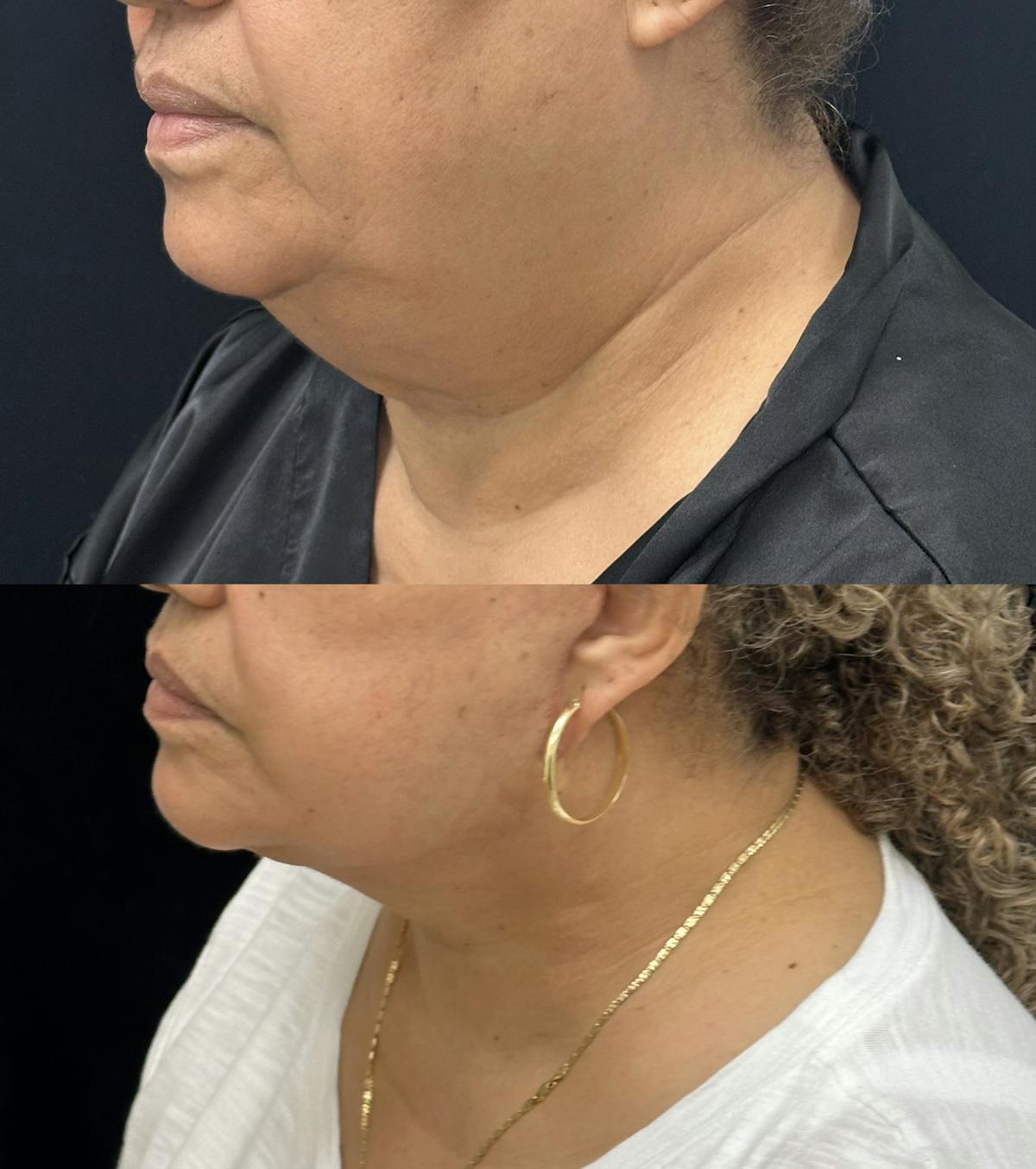 Deep Plane Facelift Before & After Gallery - Patient 966814 - Image 3