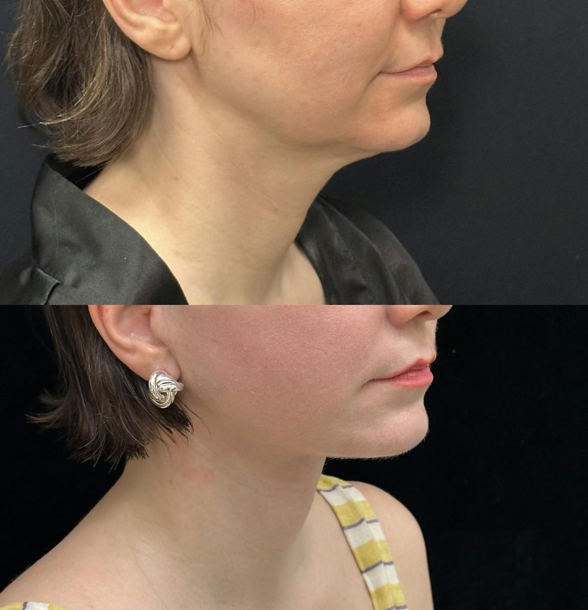 Deep Plane Facelift Before & After Gallery - Patient 110768 - Image 1