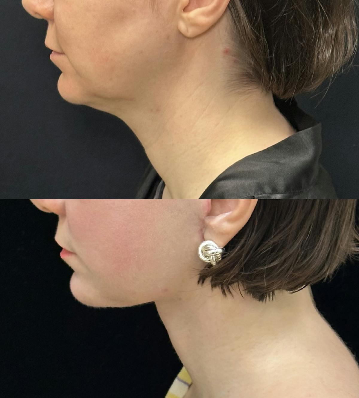 Deep Plane Facelift Before & After Gallery - Patient 110768 - Image 5