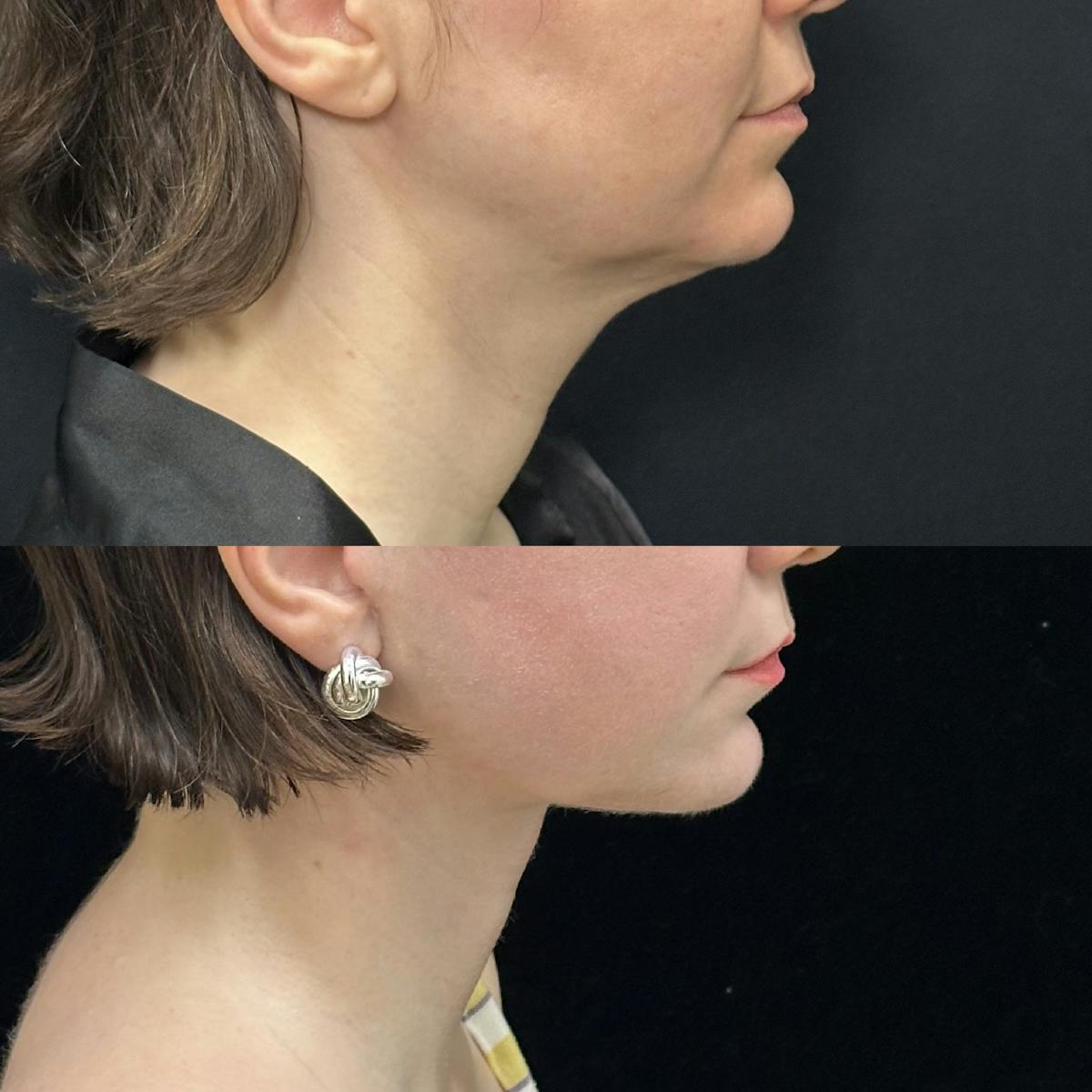 Deep Plane Facelift Before & After Gallery - Patient 110768 - Image 2