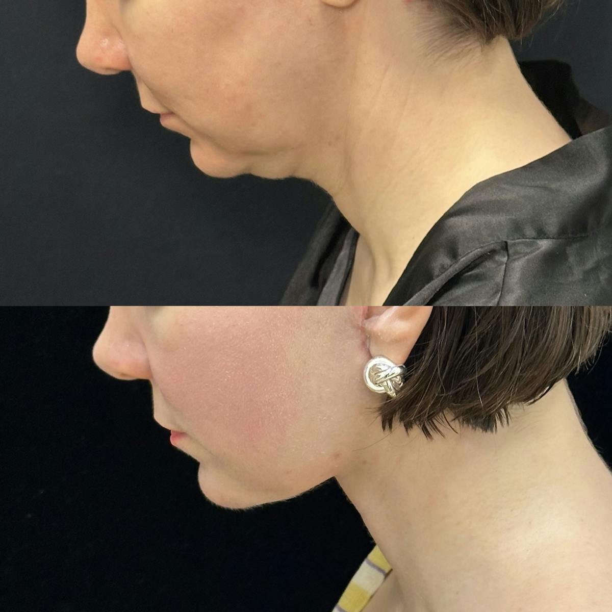 Deep Plane Facelift Before & After Gallery - Patient 110768 - Image 6