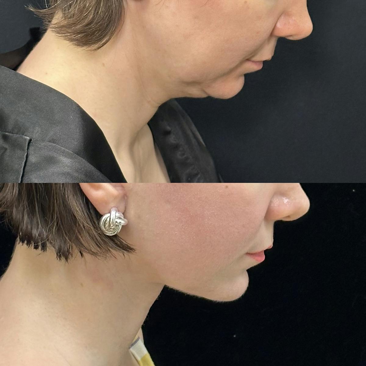 Deep Plane Facelift Before & After Gallery - Patient 110768 - Image 3
