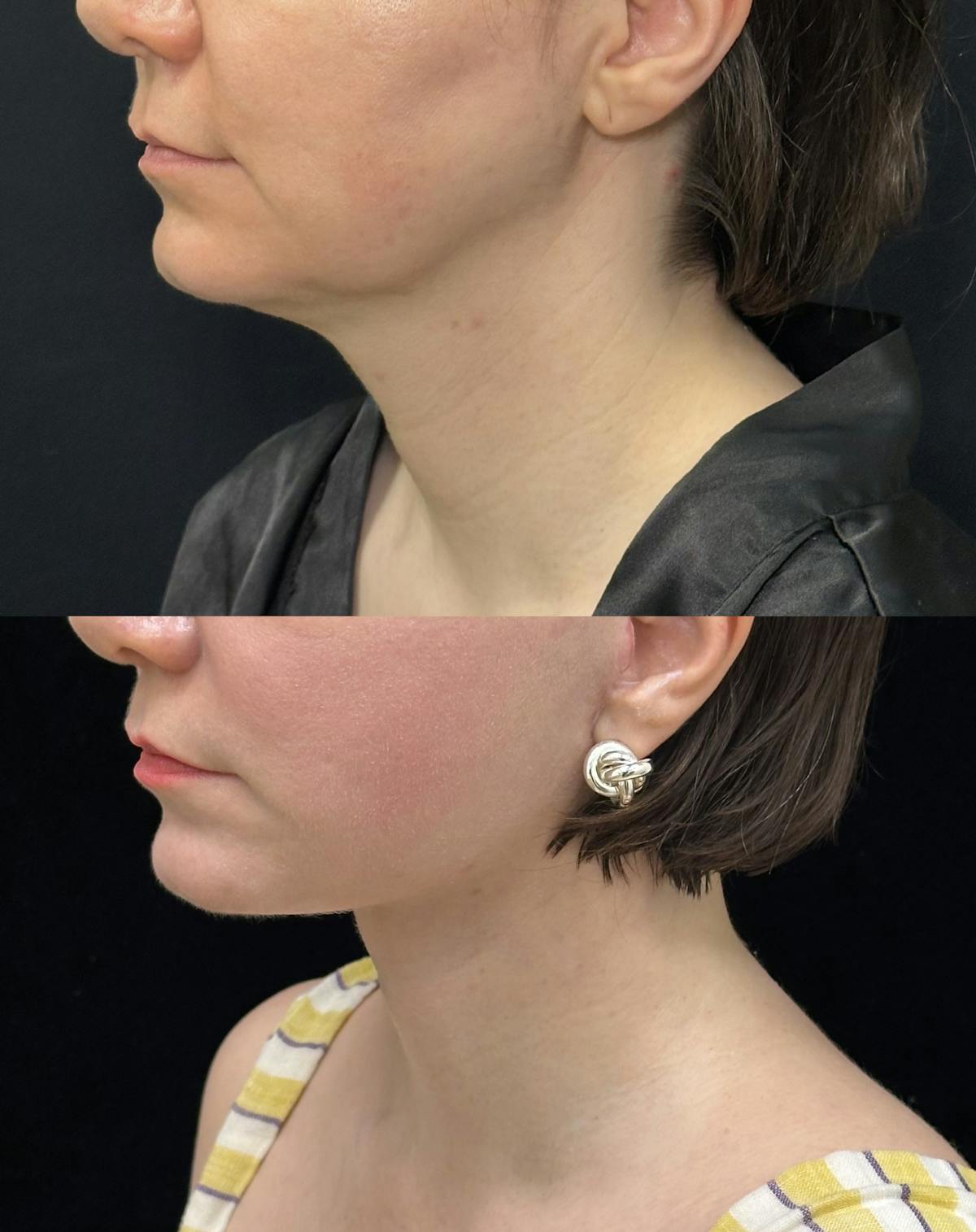 Deep Plane Facelift Before & After Gallery - Patient 110768 - Image 4