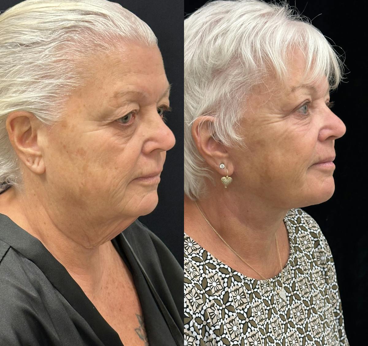Deep Plane Facelift Before & After Gallery - Patient 417701 - Image 2