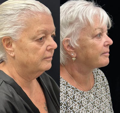 Deep Plane Facelift Before & After Gallery - Patient 417701 - Image 2
