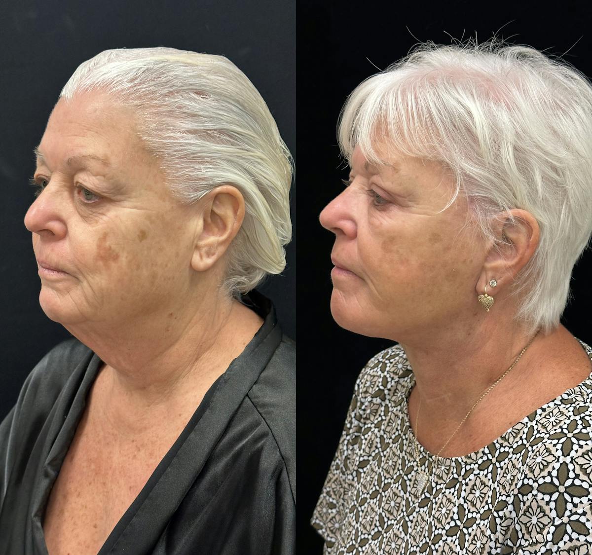 Deep Plane Facelift Before & After Gallery - Patient 417701 - Image 4