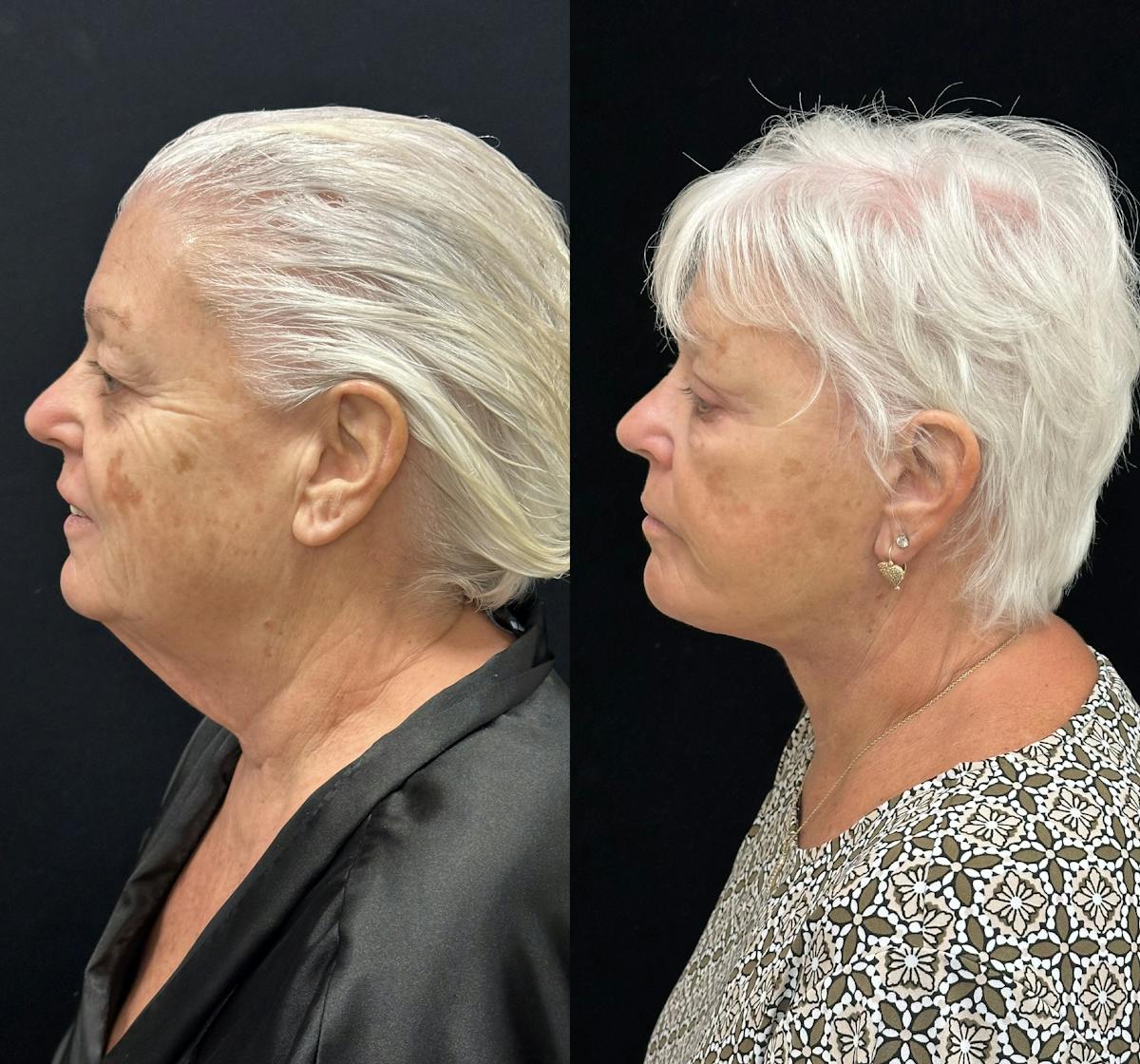 Deep Plane Facelift Before & After Gallery - Patient 417701 - Image 5