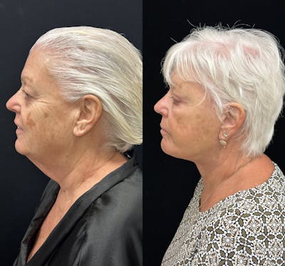 Deep Plane Facelift Before & After Gallery - Patient 417701 - Image 5