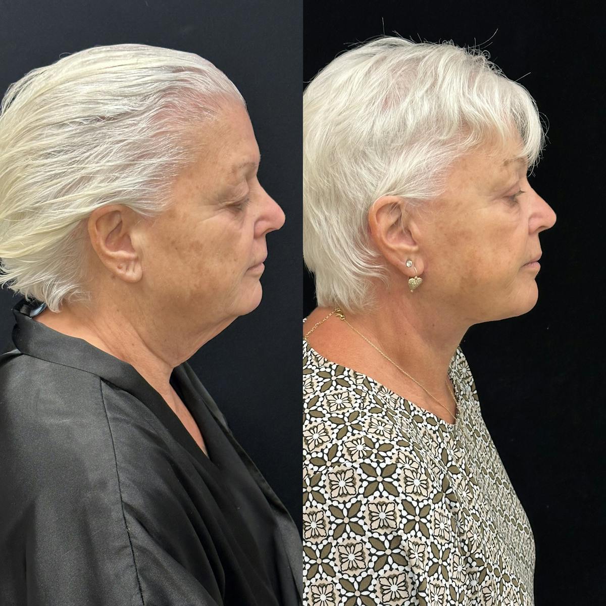 Deep Plane Facelift Before & After Gallery - Patient 417701 - Image 3