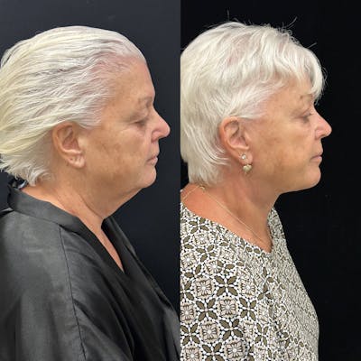 Deep Plane Facelift Before & After Gallery - Patient 417701 - Image 3