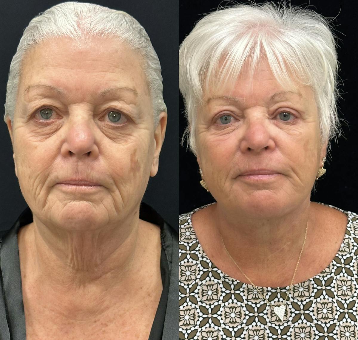Deep Plane Facelift Before & After Gallery - Patient 417701 - Image 1