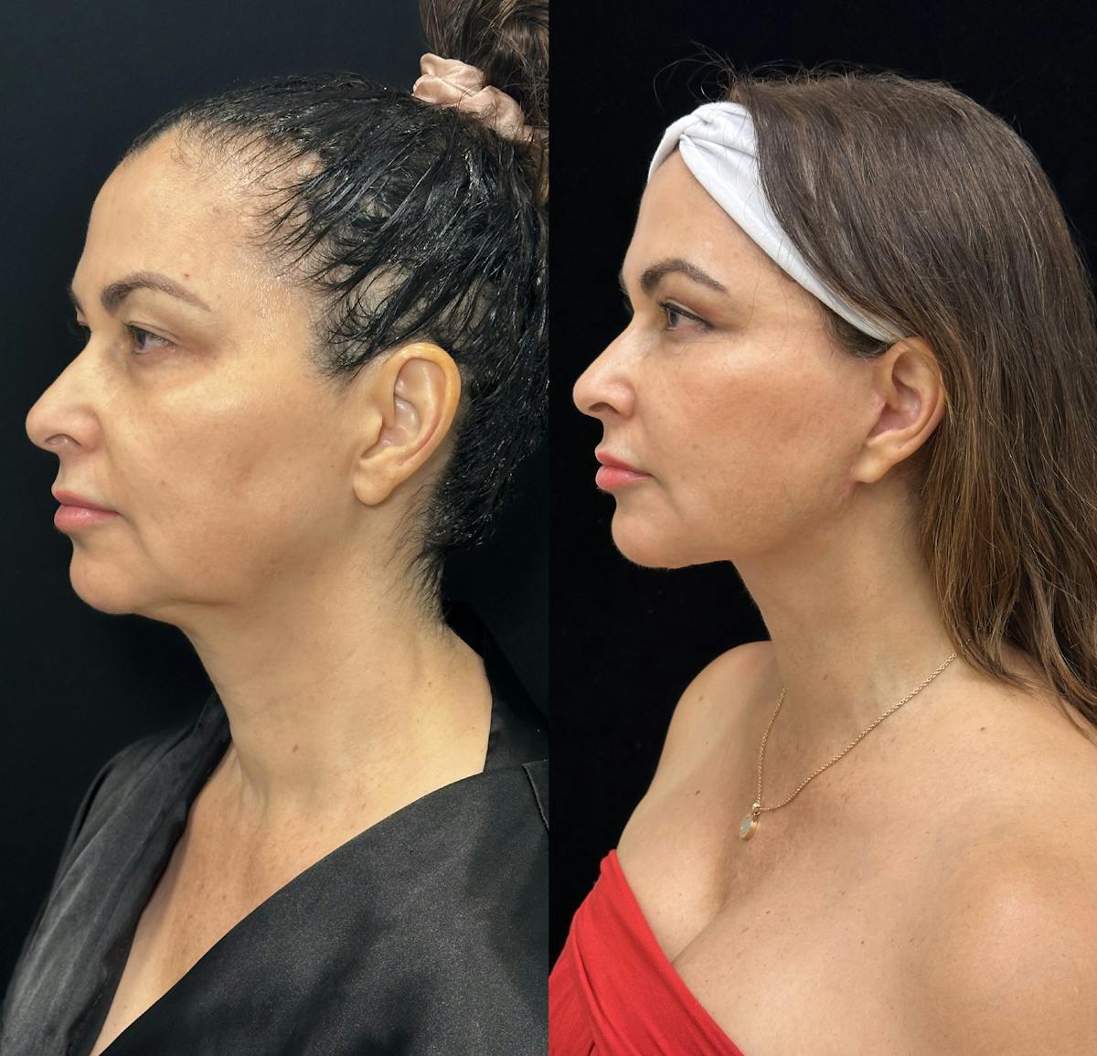 Deep Plane Facelift Before & After Gallery - Patient 409839 - Image 2