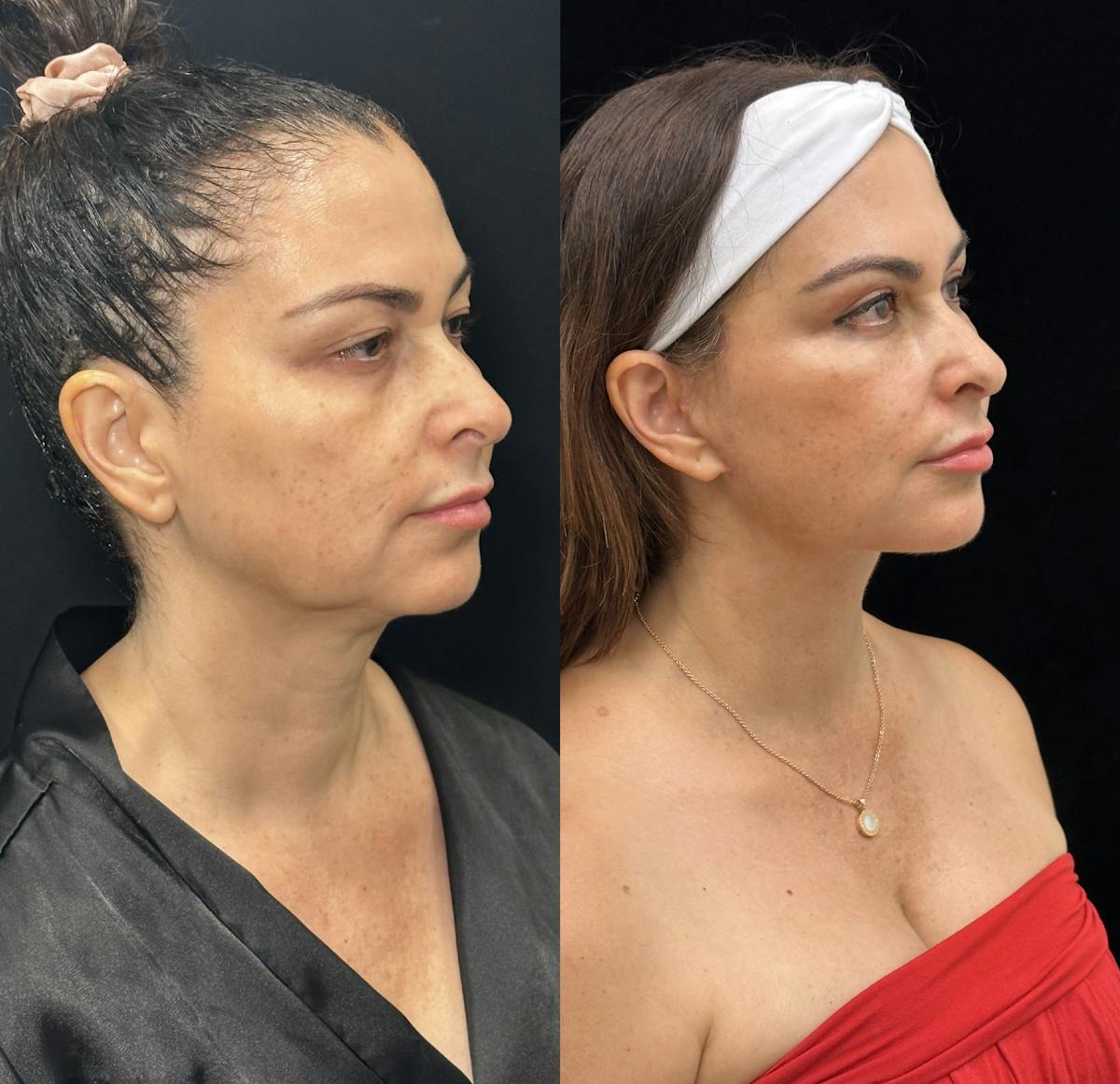 Deep Plane Facelift Before & After Gallery - Patient 409839 - Image 1